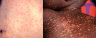 Measles example photos